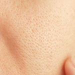 毛穴